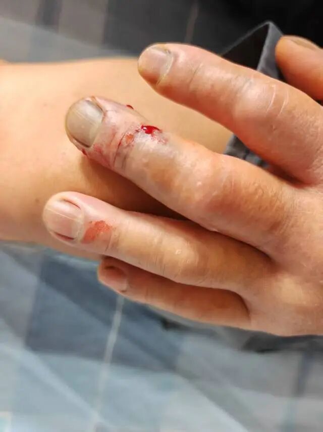 竹叶青毒蛇咬伤伤口。