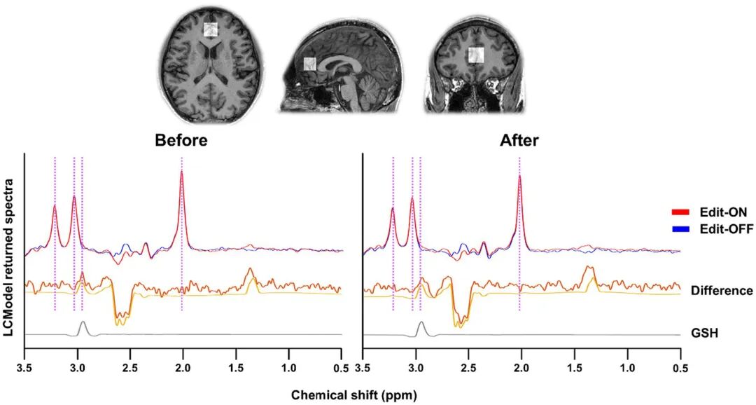 The representative GSH-edited spectra of mastication before and after from anterior cingulate cortex (ACC) by MEGA-PRESS method. Editing on (Red line) and off (Blue line) spectra were aligned and differenced. The difference spectra and spectral fitting results were described as the yellow thick and thin lines, respectively. Because GSH signal in the MR spectra is overlapped with other metabolite signals, the spectral editing technique with edit-on and edit-off MRS sequences was employed to give only GSH signal as shown in the bottom (gray line). The purple vertical lines indicate the peaks of NAA (2.01 ppm), GSH (2.95 ppm), Cr (3.03 ppm), Cho (3.21 ppm).