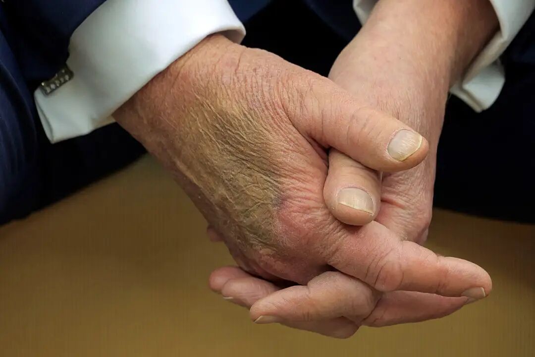 White House says that a large bruise on Trump's hand is from 'shaking hands all day every day'