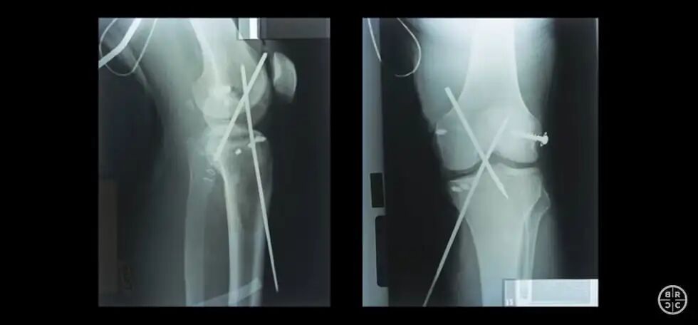 X-rays from USAF Capt. Brian Udell's surgeries after he ejected from an F-15 at mach 1.2 in 1995