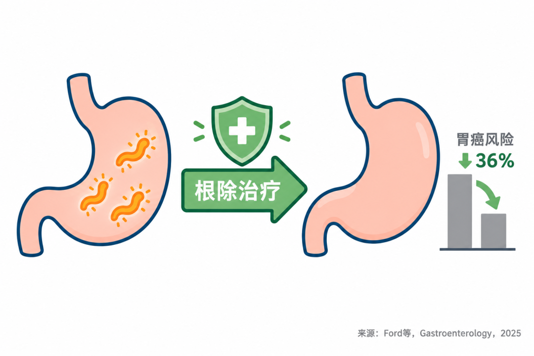 根除幽门螺杆菌后胃癌风险下降