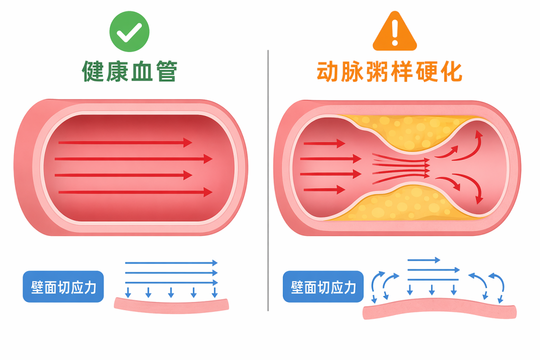 健康血管与动脉粥样硬化对比