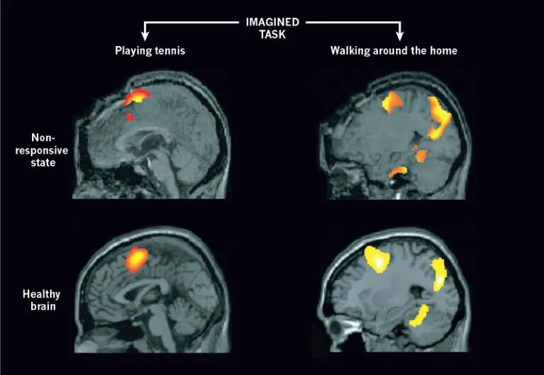 Graphic of four brain scans each with coloured areas indicating different levels of brain activity
