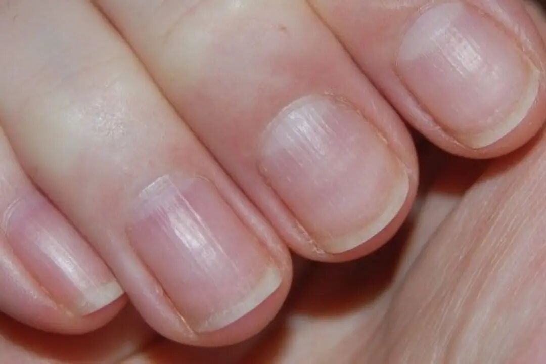 Nail ridges: an expert shares causes & how to treat – Scratch