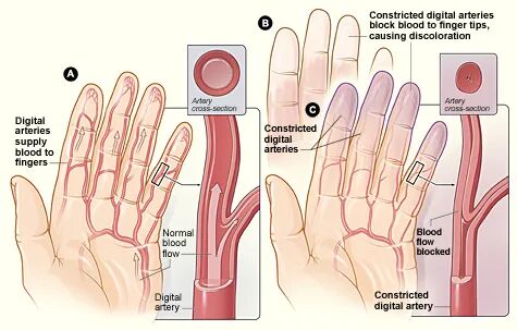 File:Raynaud's Disease.jpg